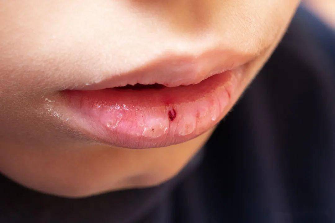 嘴唇起皮越舔越干,越干越想舔?该怎么办?
