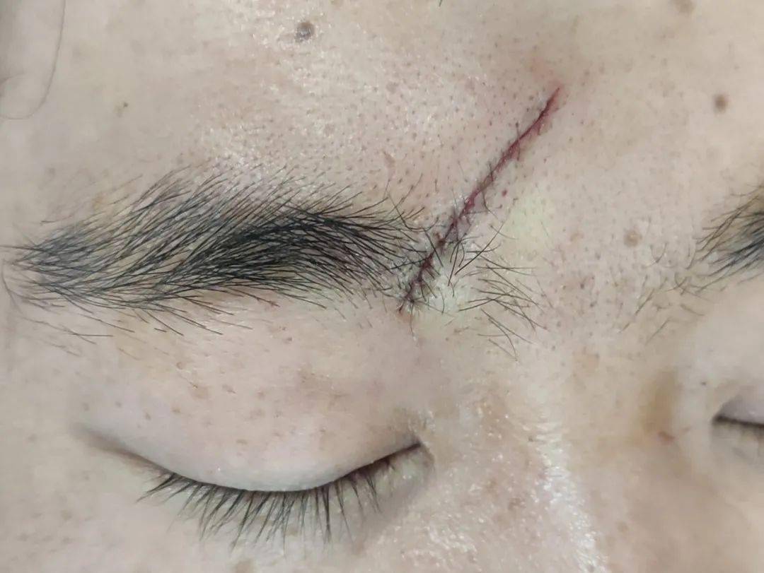 担心伤口缝针后留疤?美容缝合来帮你!_张力大_切口_工作时
