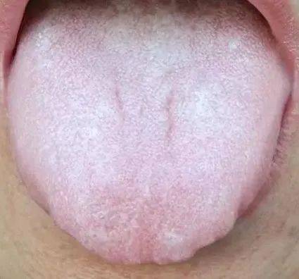 舌质胖大有齿痕