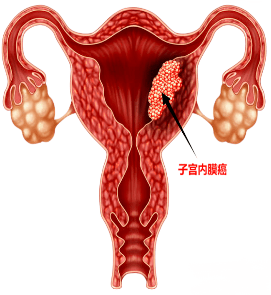 子宫体癌图片