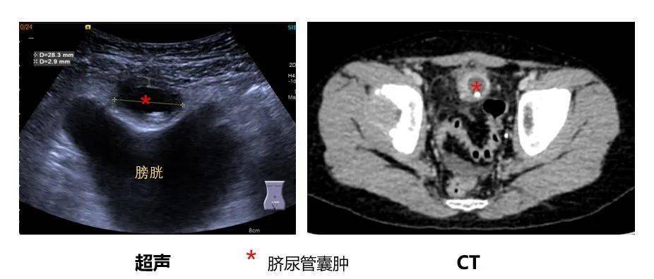 膀胱肿瘤b超图片