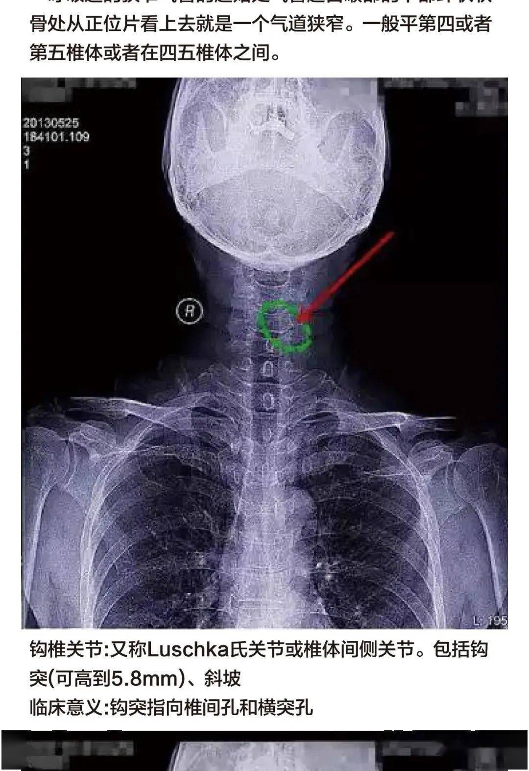 健康的颈椎图x光片图片