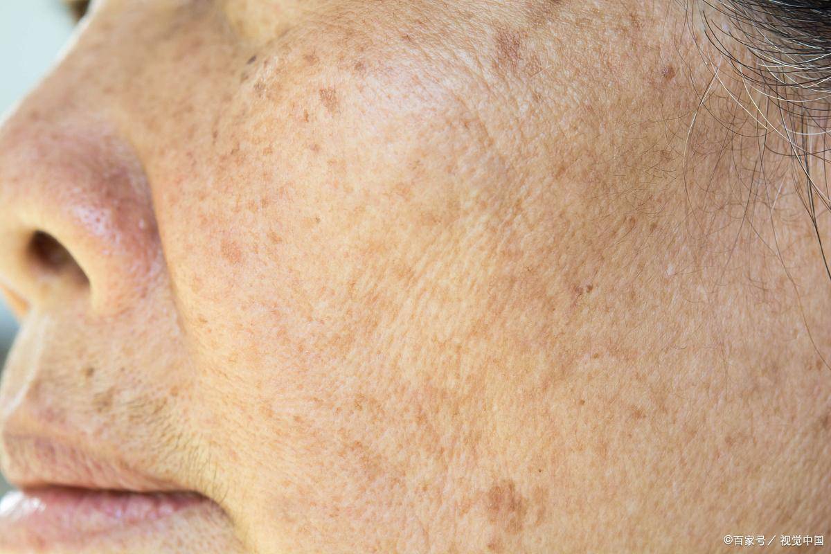 老人斑的主要形成原因,一文讲明白_皮肤_建议_紫外线