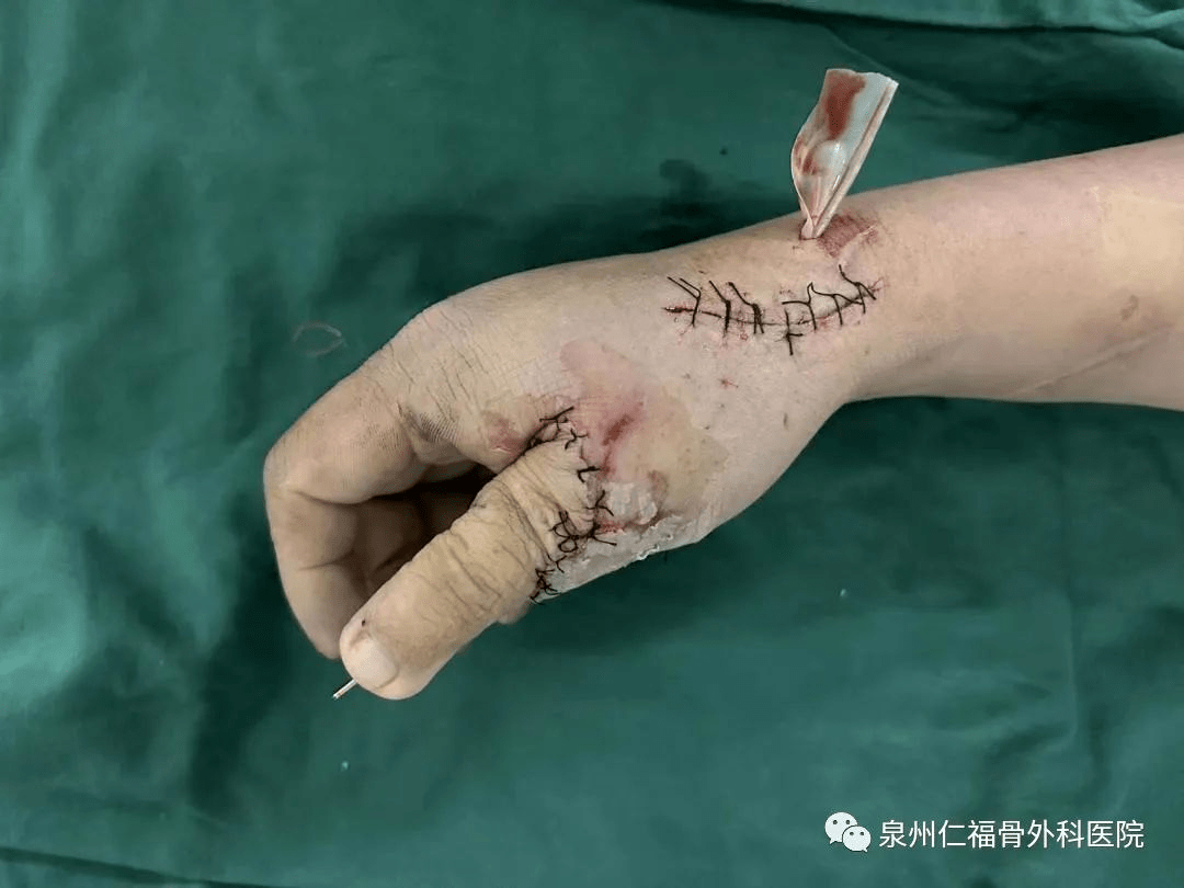 大拇指整形手术后图片图片