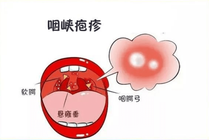 五月护娃锦囊 | 让孩子远离手足口病和疱疹性咽峡炎!_儿童_消毒_家长