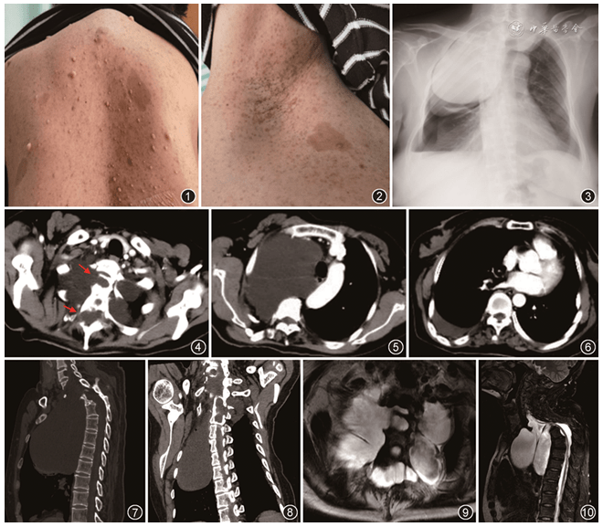 【讀片園地】右側胸腔巨大囊性腫塊影_積液_患者_皮膚