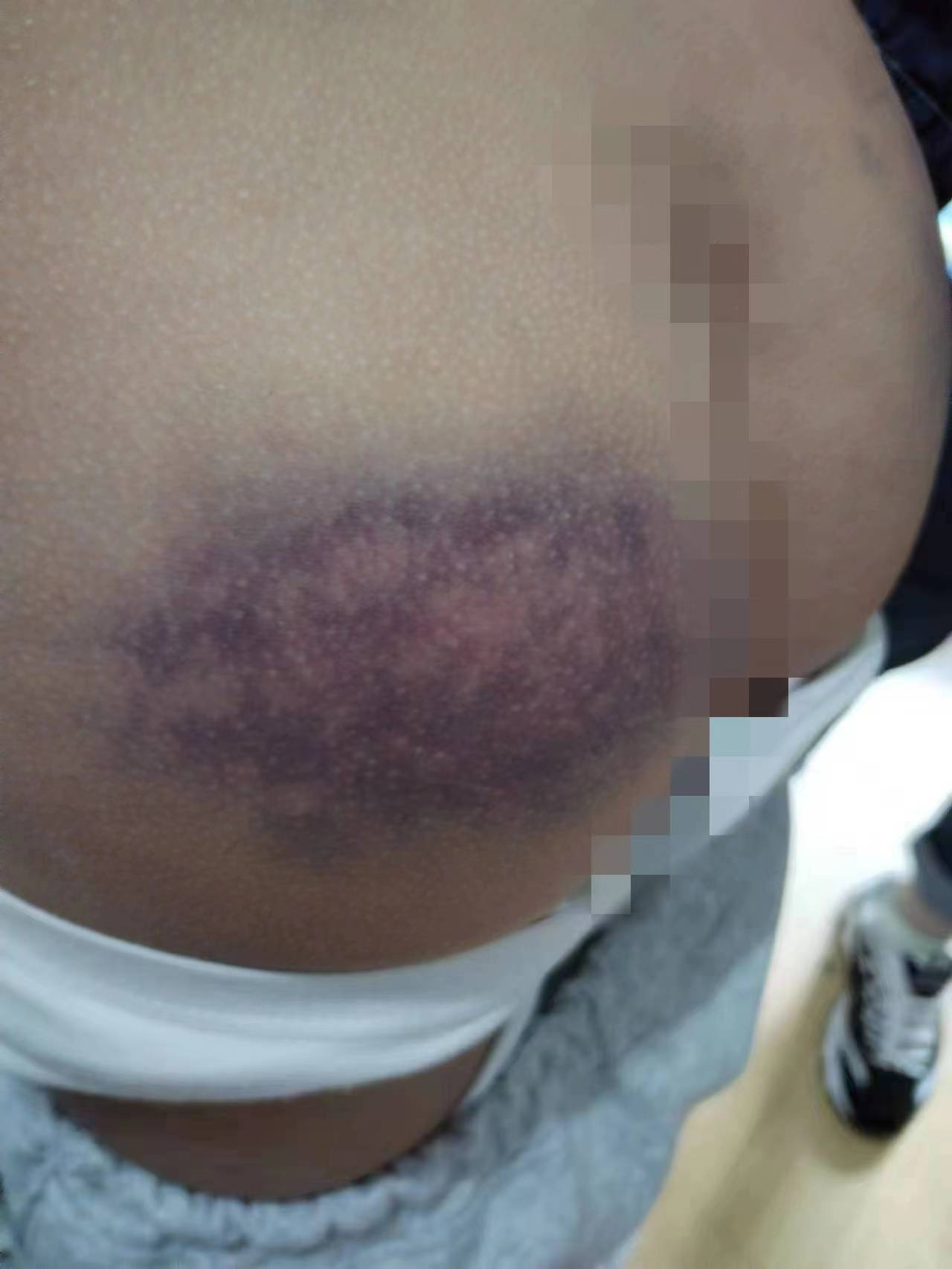 山西一班主任把学生屁股打紫,教育局:出于教育目的非恶意殴打