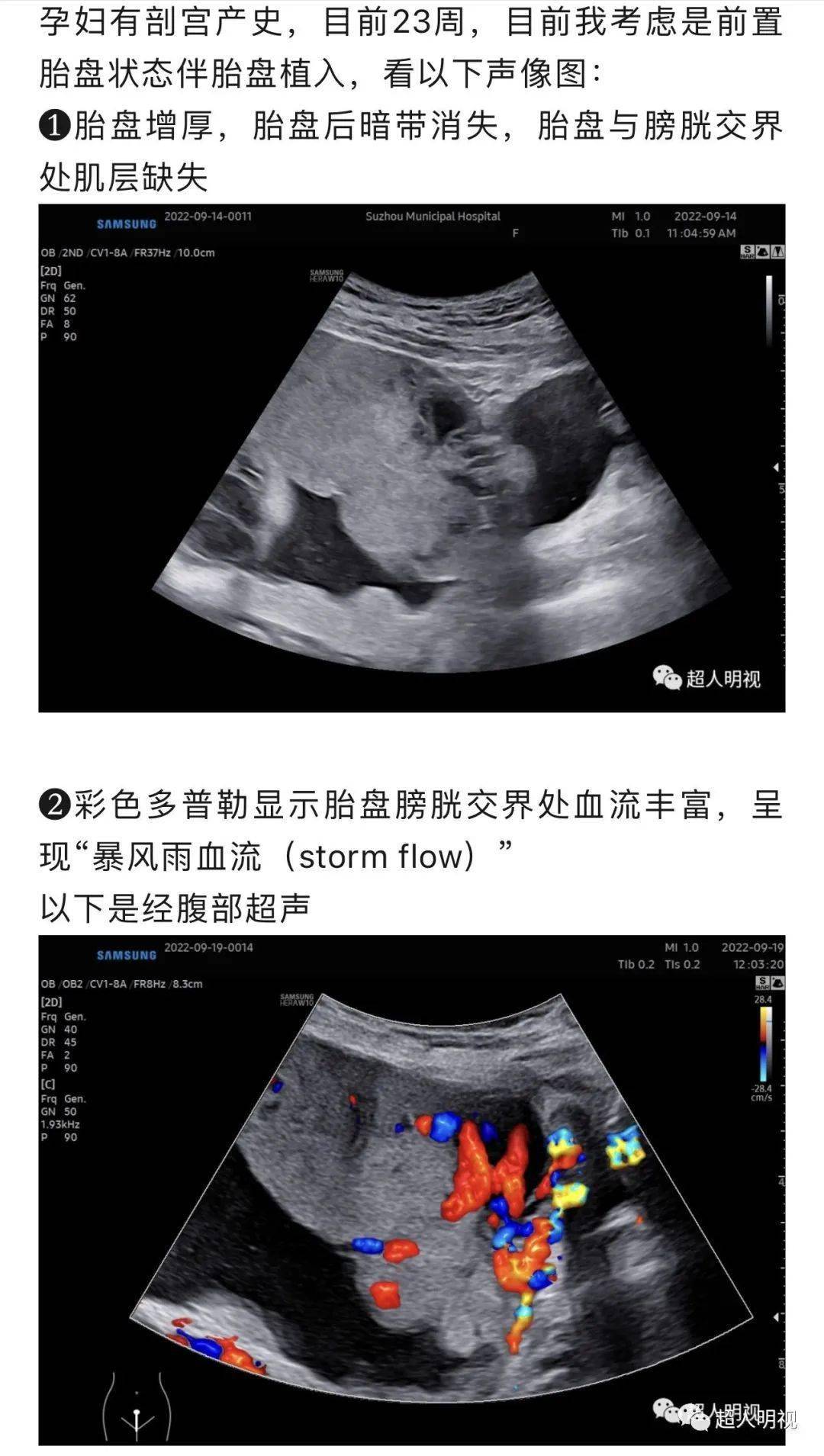 超声发现前置胎盘时的思路_进行_医生_移位