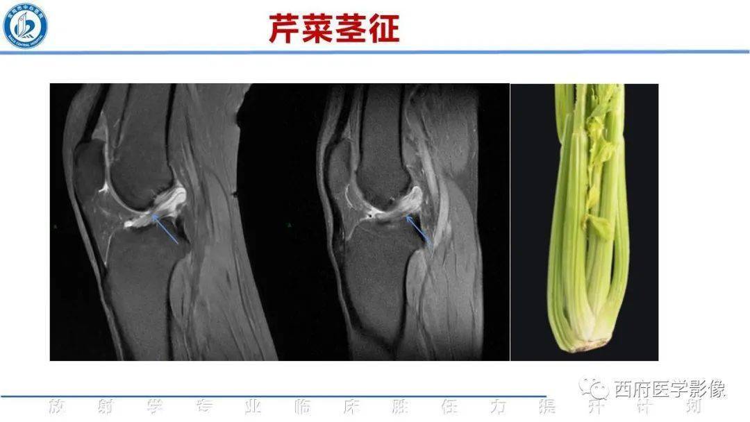 前交叉韧带粘液样变性影像诊断_平台_钙化_综合征