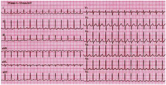 窦性心律不齐『正确答案』a7,此心电图诊断为a.窦性心动过速b.