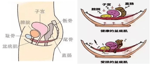 健康科普:盆底功能障碍性疾病_女性_盆腔_症状