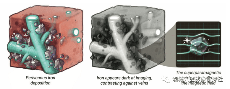 iron deposition surrounding the hepatic veins of cirrhotic