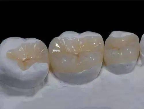 为什么牙医让你选择嵌体修复?_牙齿_医生_传统
