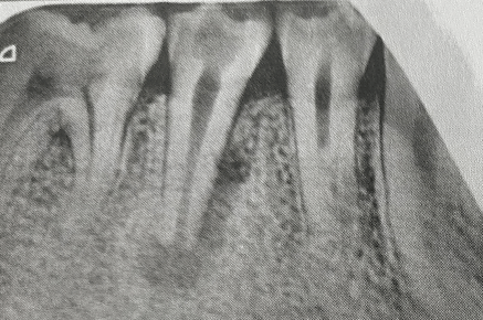侧切牙畸形中央尖图片