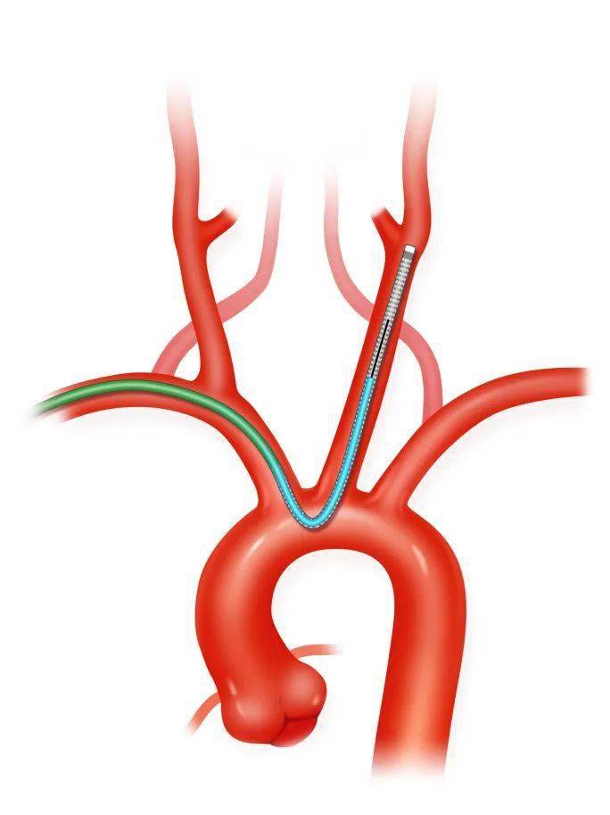 桡而有信,同道而行|trust经桡中间导管同轴技术详解_tethys_simmons