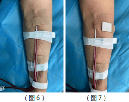 静脉输液胶布固定步骤图片