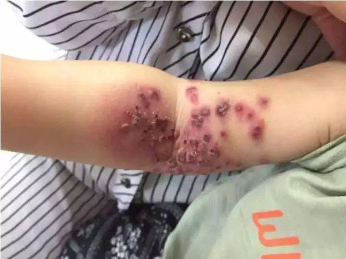 婴儿被亲友轮番亲吻高烧近40度._病毒_孩子_传播
