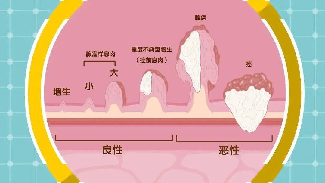 (肠癌的发病历程)肠癌的典型症状有:排便习惯改变,多表现为排便次数