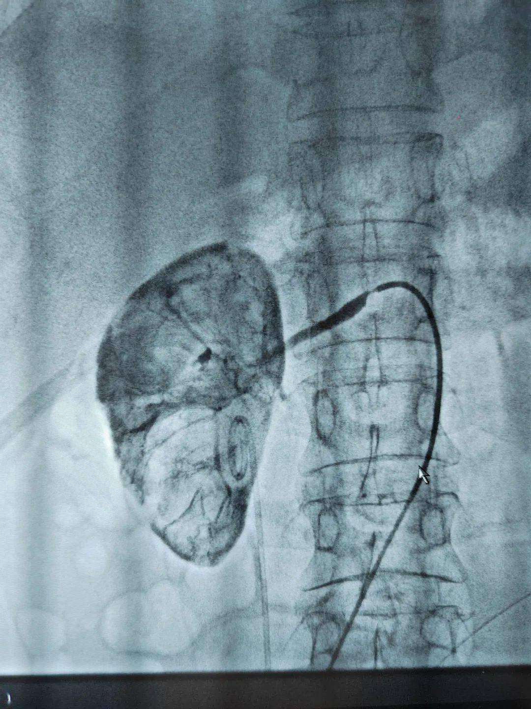 精准治疗丨肾动脉造影 栓塞术—"小切口"解决肾出血患者"大问题"_肿瘤