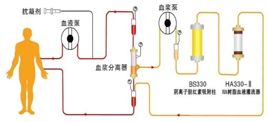 mars人工肝示意图图片