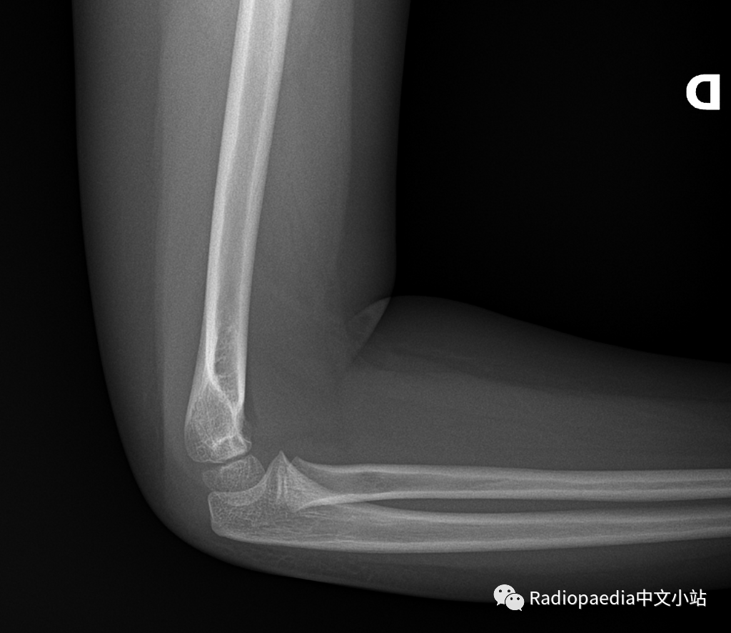 正常肘关节x光片图片图片