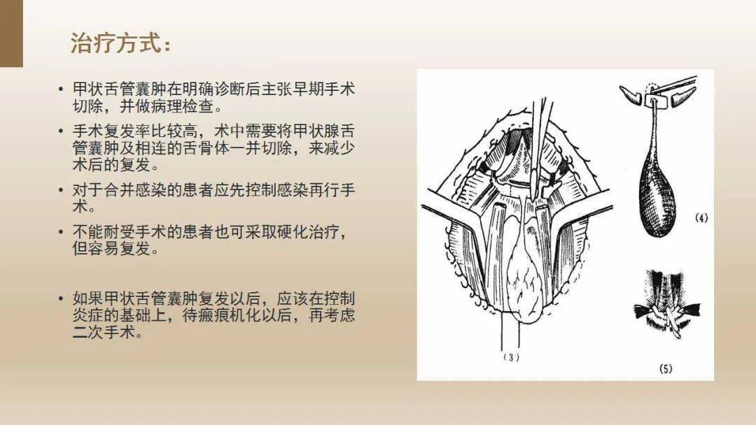 甲状腺舌管囊肿 来自搜狐网