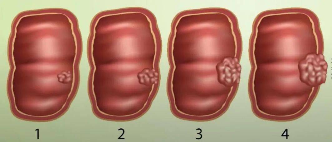 息肉会自己消失吗图片