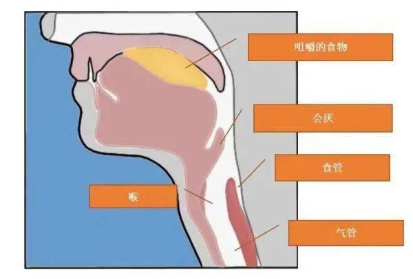 喉痛,呼吸困难,当心 " 夺命凶手 "急性会厌炎!_治疗_病情_症状