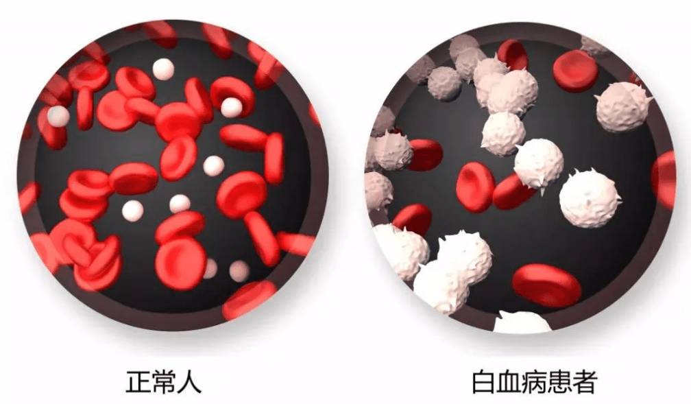 为什么越来越多的孩子得白血病?