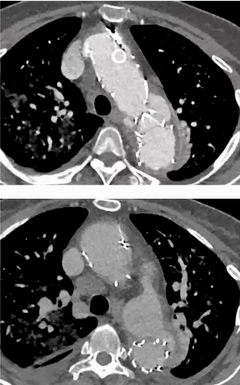 支架周围模糊渗出;心脏超声可见瓣叶赘生物