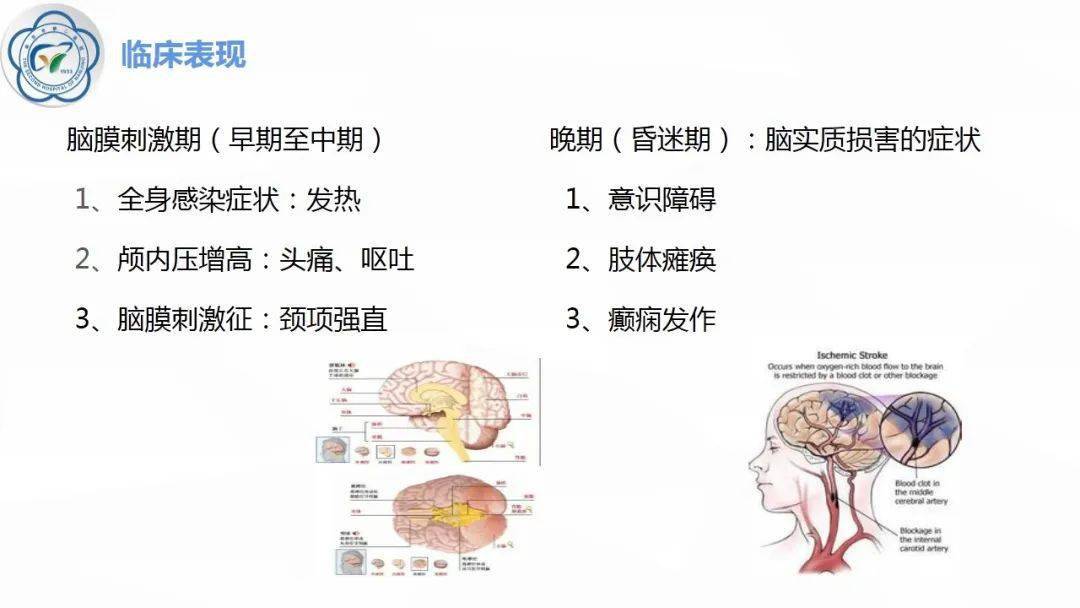 结核性脑膜炎头痛图片