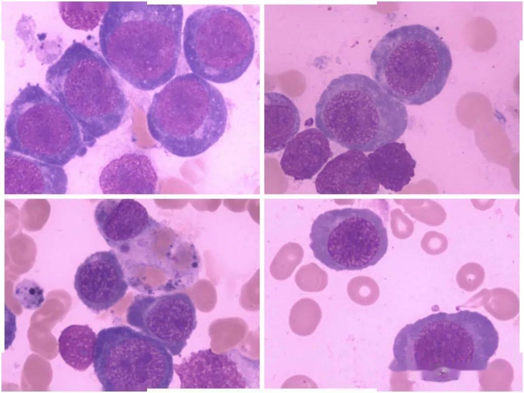 巨幼红细胞性贫血图片