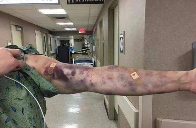 为了更好的服务于患者,提升采血人员的业务水准,将工作中遇到的静脉