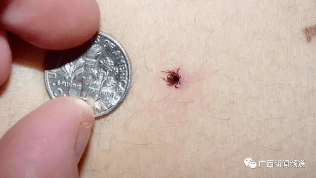 桂林一男子野外钓鱼感染恙虫病,高烧40度危及生命_王医生_广西_丛林