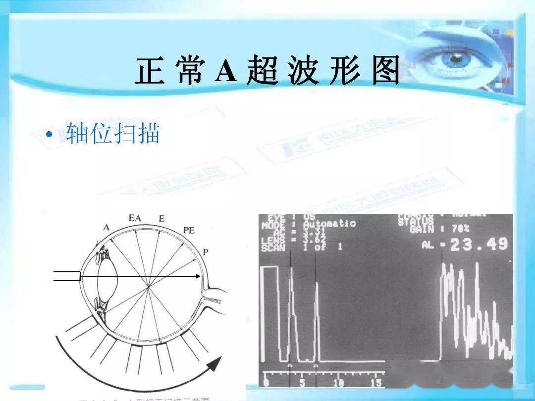 眼科a超的基本原理和临床应用