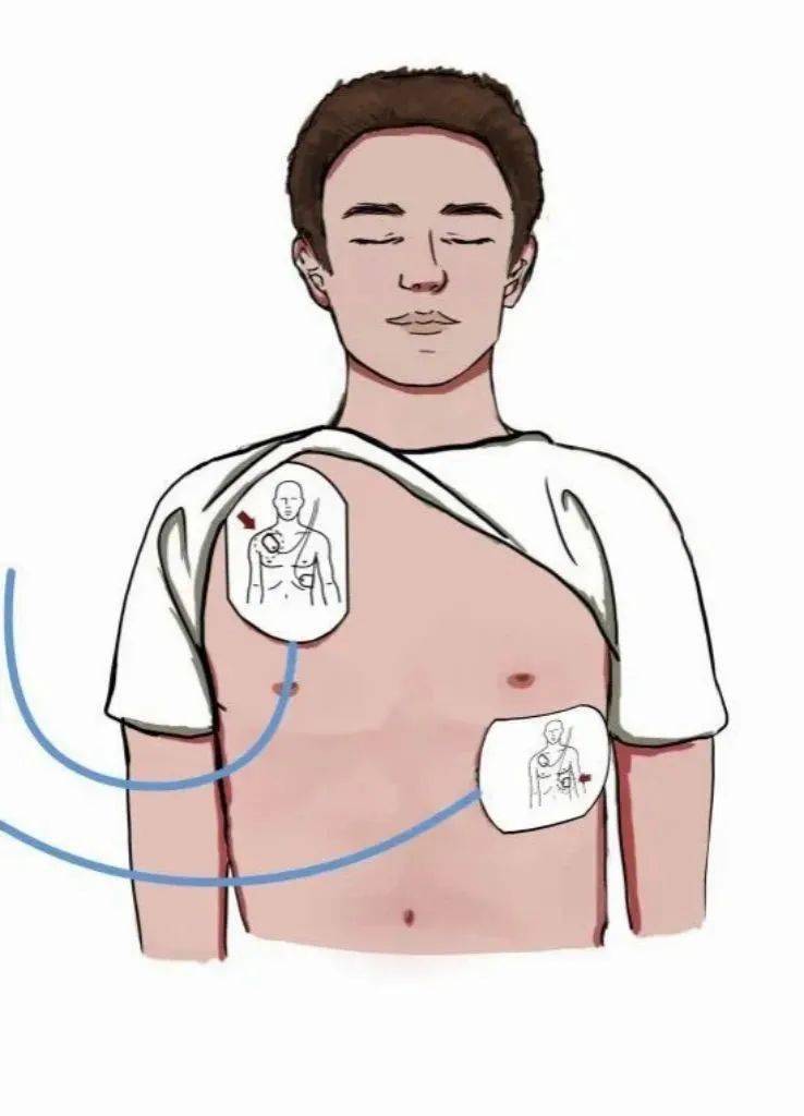 锁骨之下),另一片电极片贴在患者左乳头外侧(左腋前线之后第五肋间处)