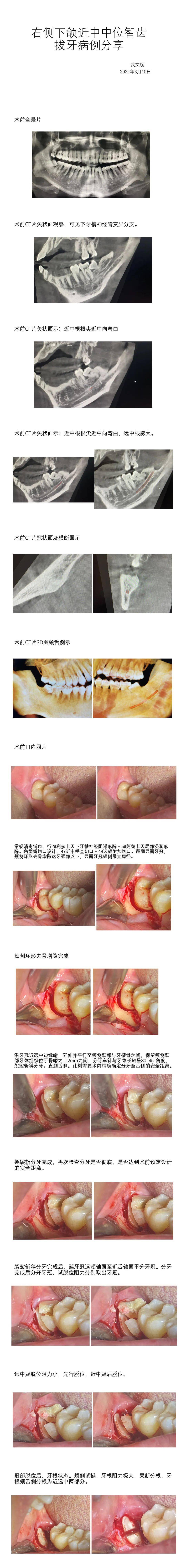 【优秀病例分享】下颌近中中位智齿拔牙病例