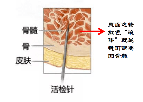 mpn家园携手血液专家一起为您揭开有关骨髓穿刺的秘密