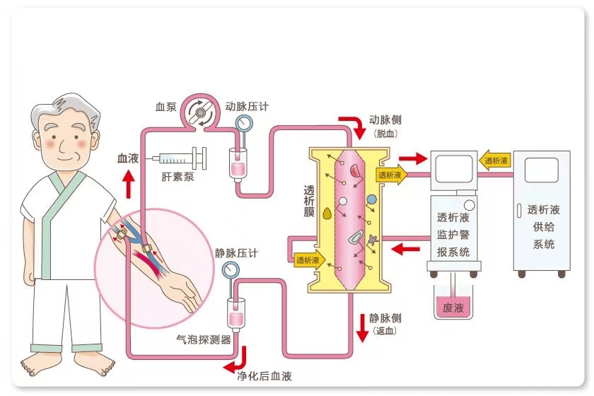 透析瘘管手术步骤图解图片