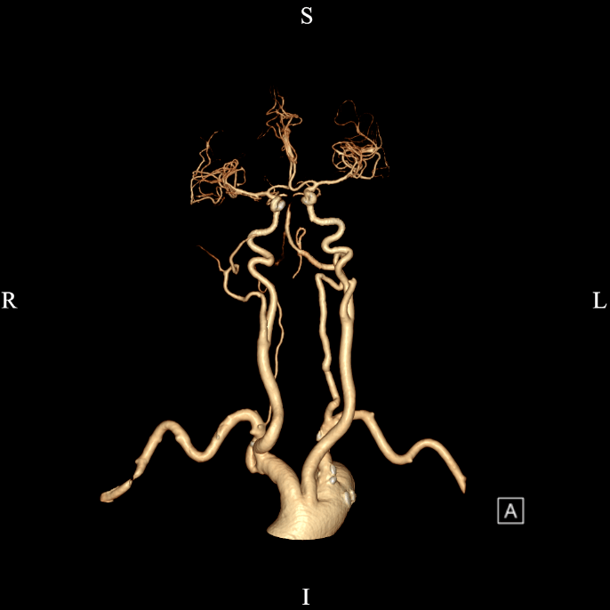 椎底动脉图片
