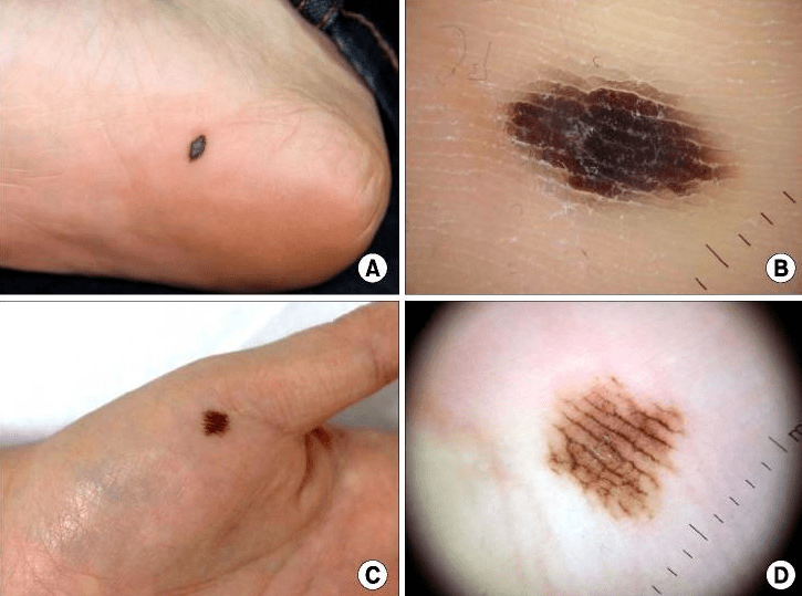 你身上的痣,癌变可能有多大_中国_发病率_皮肤