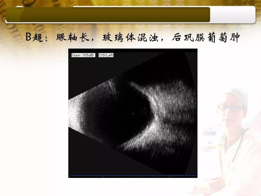临床上常见的病理性近视患者眼底相及b超