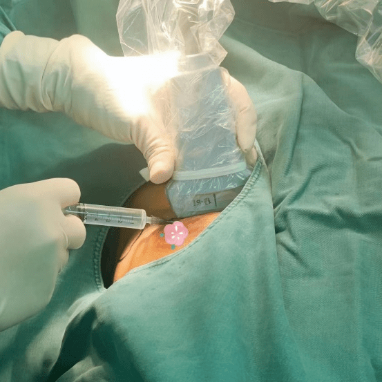 乳腺微创手术旋切图片