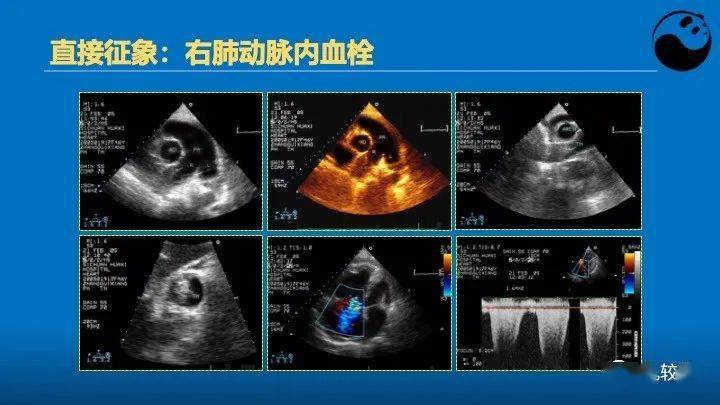 临床医生如何解读超声心动图报告_心脏_病例_患者