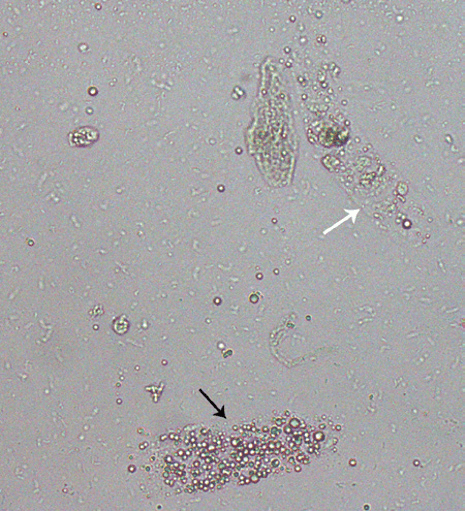 最新资料整理的尿检图谱:48张图片展示尿液中的颗粒管型