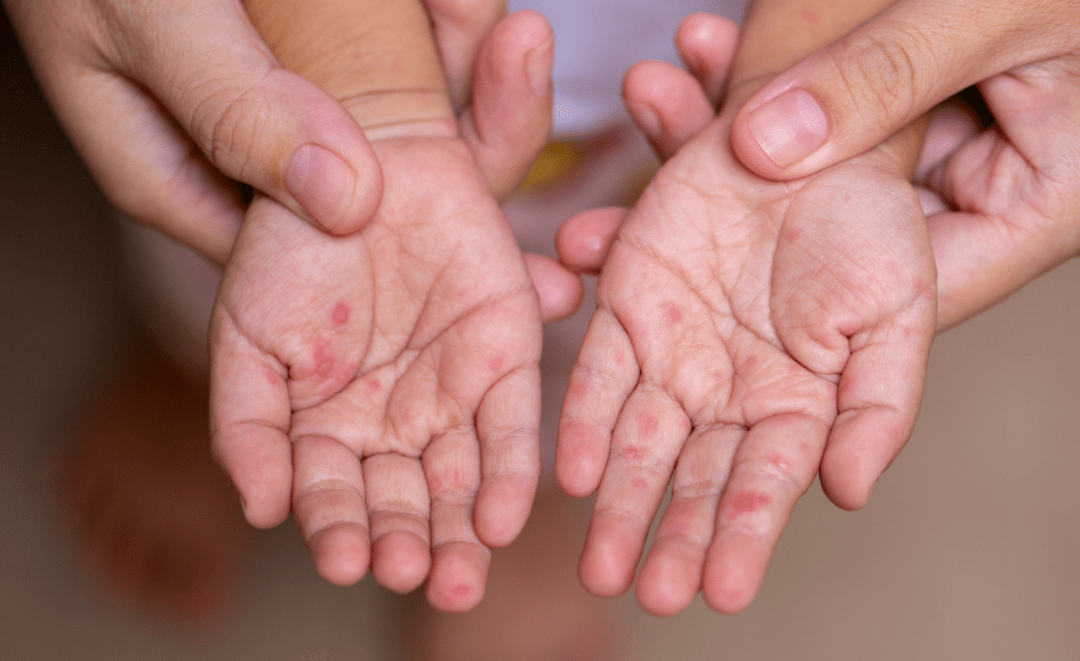 手足口病是一种由肠道病毒(ev)感染引起的传染病,因5岁以下儿童为手足