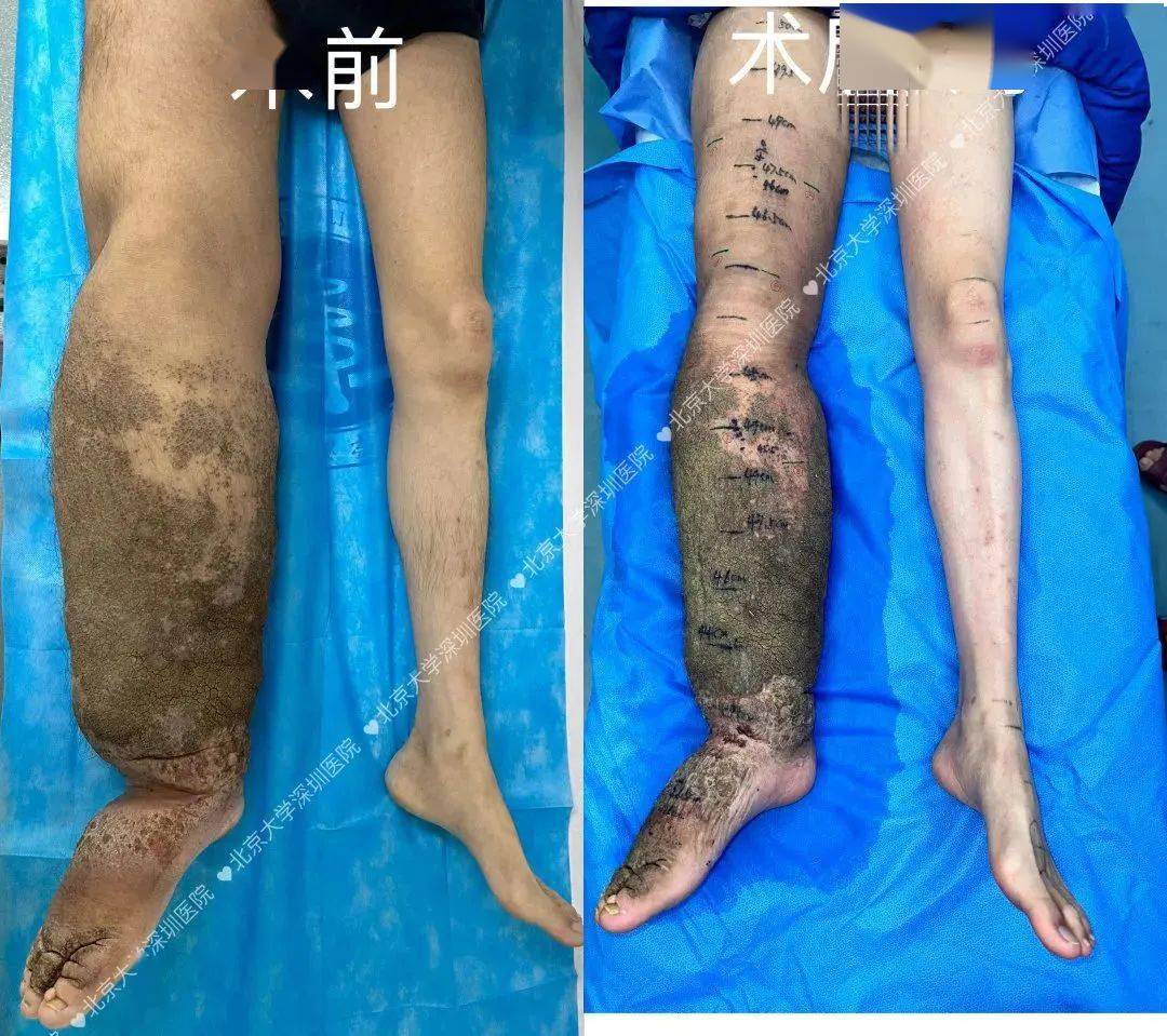 手术,这次手术的5个小孔分布在整条腿的不同位置,因为脂肪层,皮肤增厚