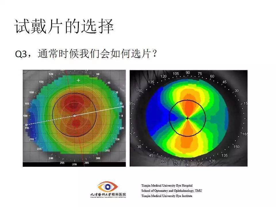 【眼视光】 角膜塑形镜验配流程