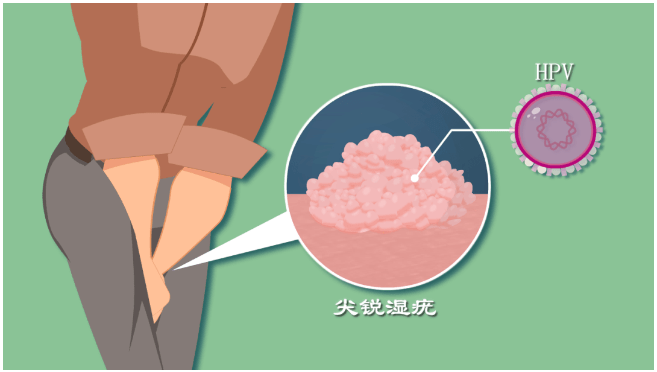 外阴疣状癌图片图片