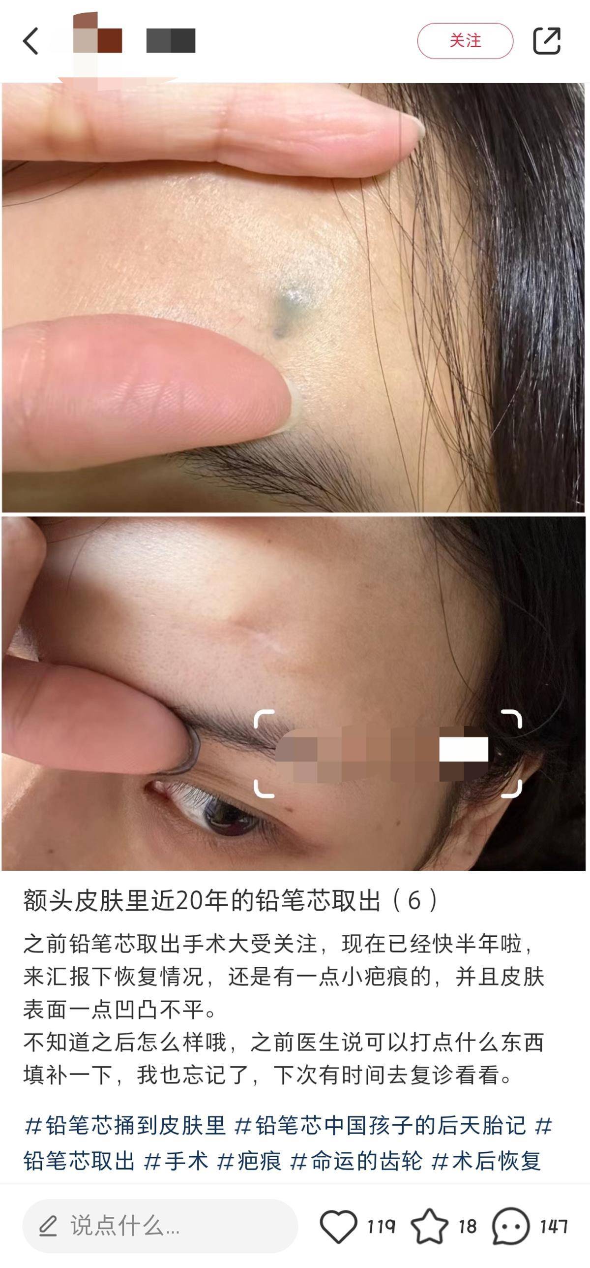 铅笔芯戳进额头20年,女子手术取出后还能写字_女生_网友_视频